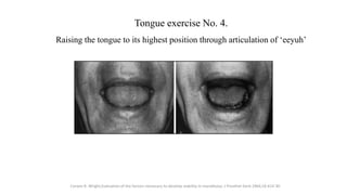 Tongue exercise No. 4.
Raising the tongue to its highest position through articulation of ‘eeyuh’
Corwin R. Wright,Evaluat...