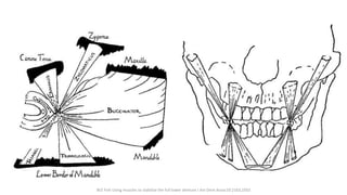 W.E Fish Using muscles to stabilize the full lower denture J Am Dent Assoc10:2163,1933
 
