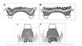 Victor E. Beresin, Frank J. Schiesser, The neutral zone in complete dentures, In The Journal of Prosthetic Dentistry, Volu...
