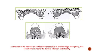 Stability in Complete Denture [Autosaved].pptx