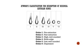 Stability in Complete Denture [Autosaved].pptx