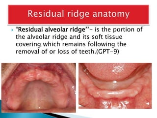 Stability in complete dentures | PPTX