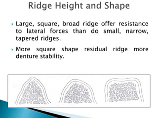 Sufficient Ridges Stability in complete dentures | PPTX
