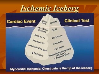 Ischemic IcebergIschemic Iceberg
 
