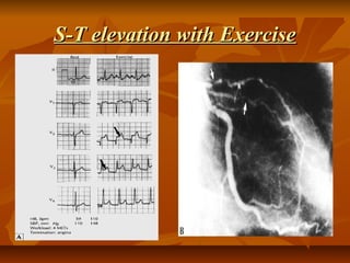 S-T elevation with ExerciseS-T elevation with Exercise
 