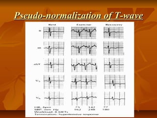 Pseudo-normalization of T-wavePseudo-normalization of T-wave
 