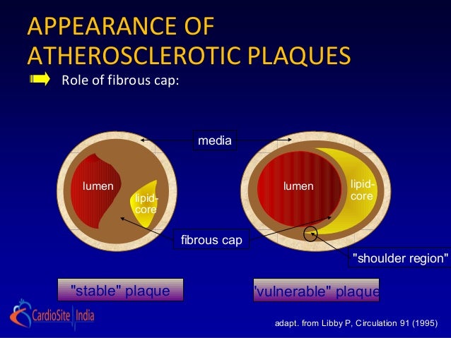 Stable ischemic heart ...