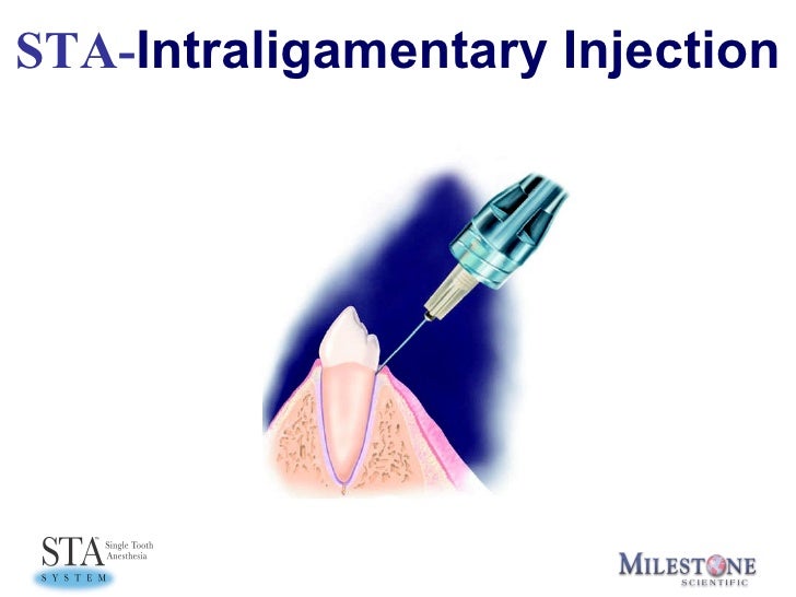 Sta Features Training Intralig.Inject. Erc