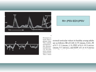 RI= (PSV-EDV)/PSV
 