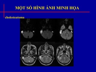 MỘT SỐ HÌNH ẢNH MINH HỌA
cholesteatoma
 