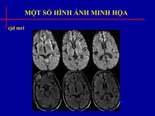 MỘT SỐ HÌNH ẢNH MINH HỌA
cjd mri
 