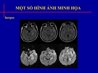 MỘT SỐ HÌNH ẢNH MINH HỌA
herpes
 