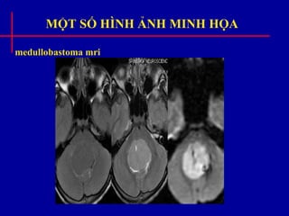 MỘT SỐ HÌNH ẢNH MINH HỌA
medullobastoma mri
 