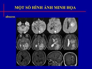 MỘT SỐ HÌNH ẢNH MINH HỌA
abscess
 