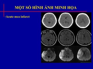 MỘT SỐ HÌNH ẢNH MINH HỌA
-Acute mca infarct
 