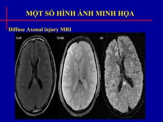 MỘT SỐ HÌNH ẢNH MINH HỌA
Diffuse Axonal injury MRI
 