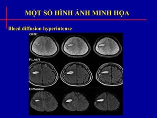 MỘT SỐ HÌNH ẢNH MINH HỌA
Bleed diffusion hyperintense
 