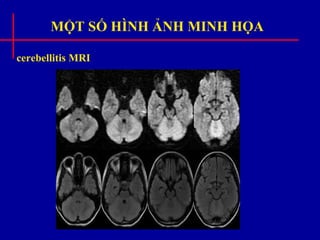 MỘT SỐ HÌNH ẢNH MINH HỌA
cerebellitis MRI
 