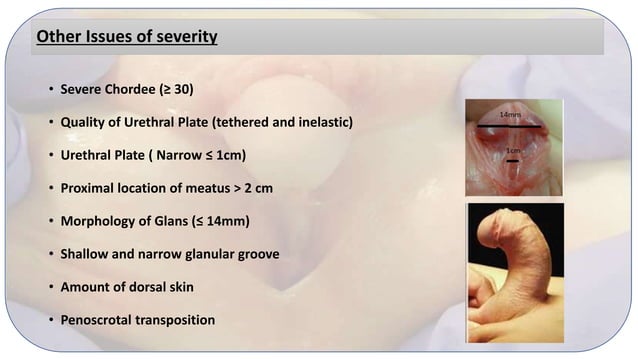 Staged urethroplasty decision making | PPT