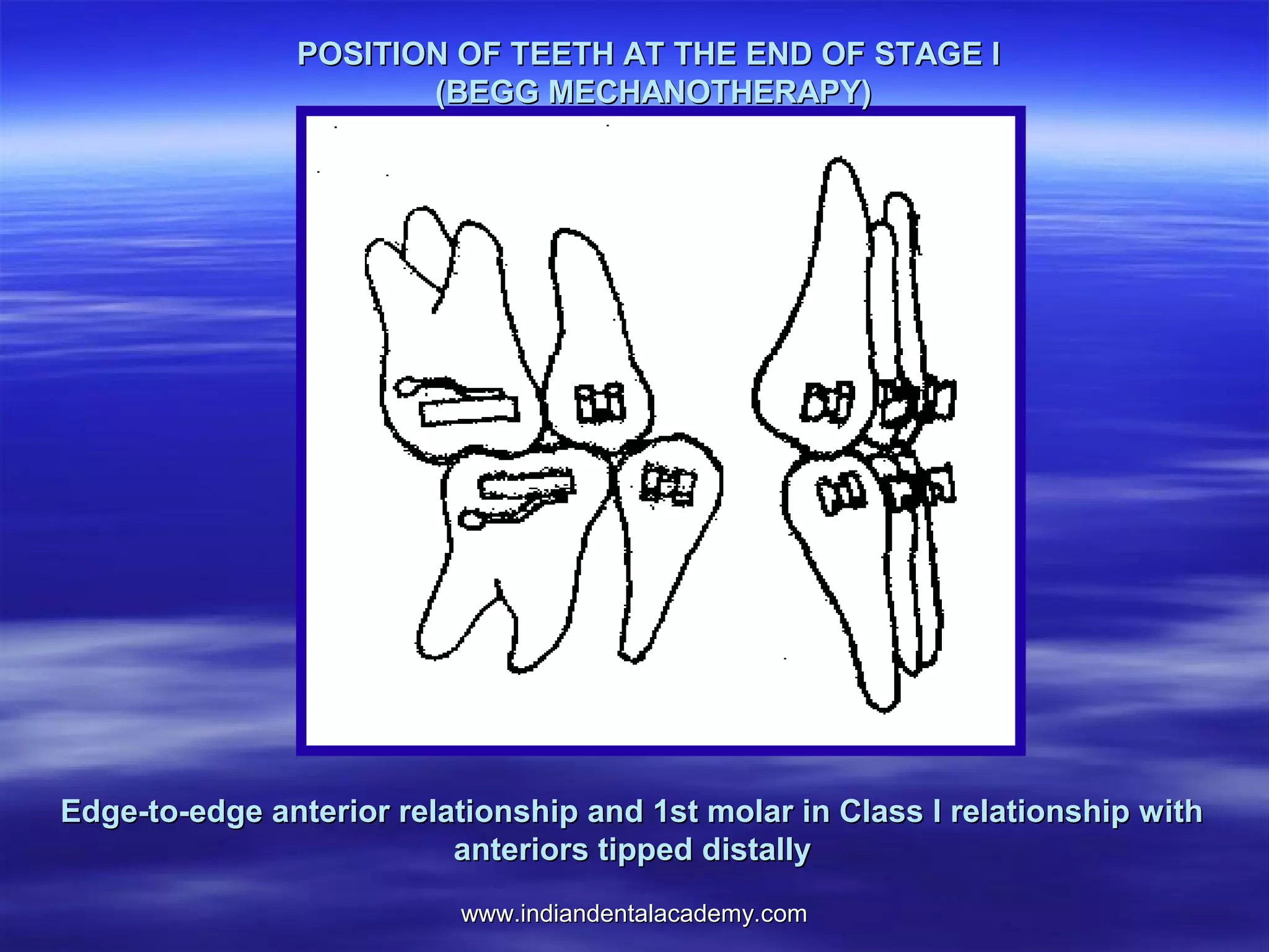 www.indiandentalacademy.comwww.indiandentalacademy.com
Edge-to-edge anterior relationship and 1st molar in Class I relationship withEdge-to-edge anterior relationship and 1st molar in Class I relationship with
anteriors tipped distallyanteriors tipped distally
POSITION OF TEETH AT THE END OF STAGE IPOSITION OF TEETH AT THE END OF STAGE I
(BEGG MECHANOTHERAPY)(BEGG MECHANOTHERAPY)
 