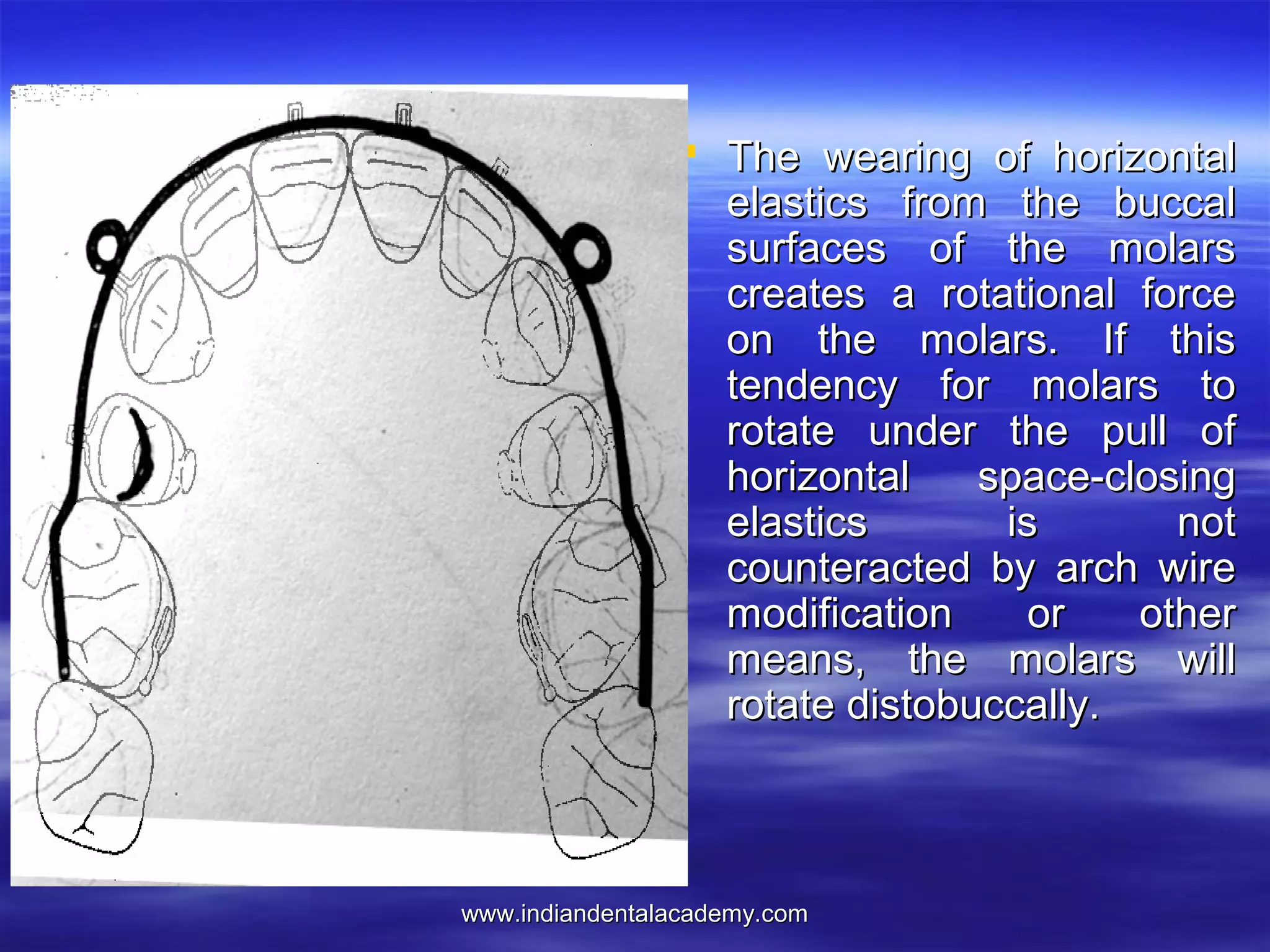 www.indiandentalacademy.comwww.indiandentalacademy.com
 The wearing of horizontalThe wearing of horizontal
elastics from the buccalelastics from the buccal
surfaces of the molarssurfaces of the molars
creates a rotational forcecreates a rotational force
on the molars. If thison the molars. If this
tendency for molars totendency for molars to
rotate under the pull ofrotate under the pull of
horizontal space-closinghorizontal space-closing
elastics is notelastics is not
counteracted by arch wirecounteracted by arch wire
modification or othermodification or other
means, the molars willmeans, the molars will
rotate distobuccally.rotate distobuccally.
 