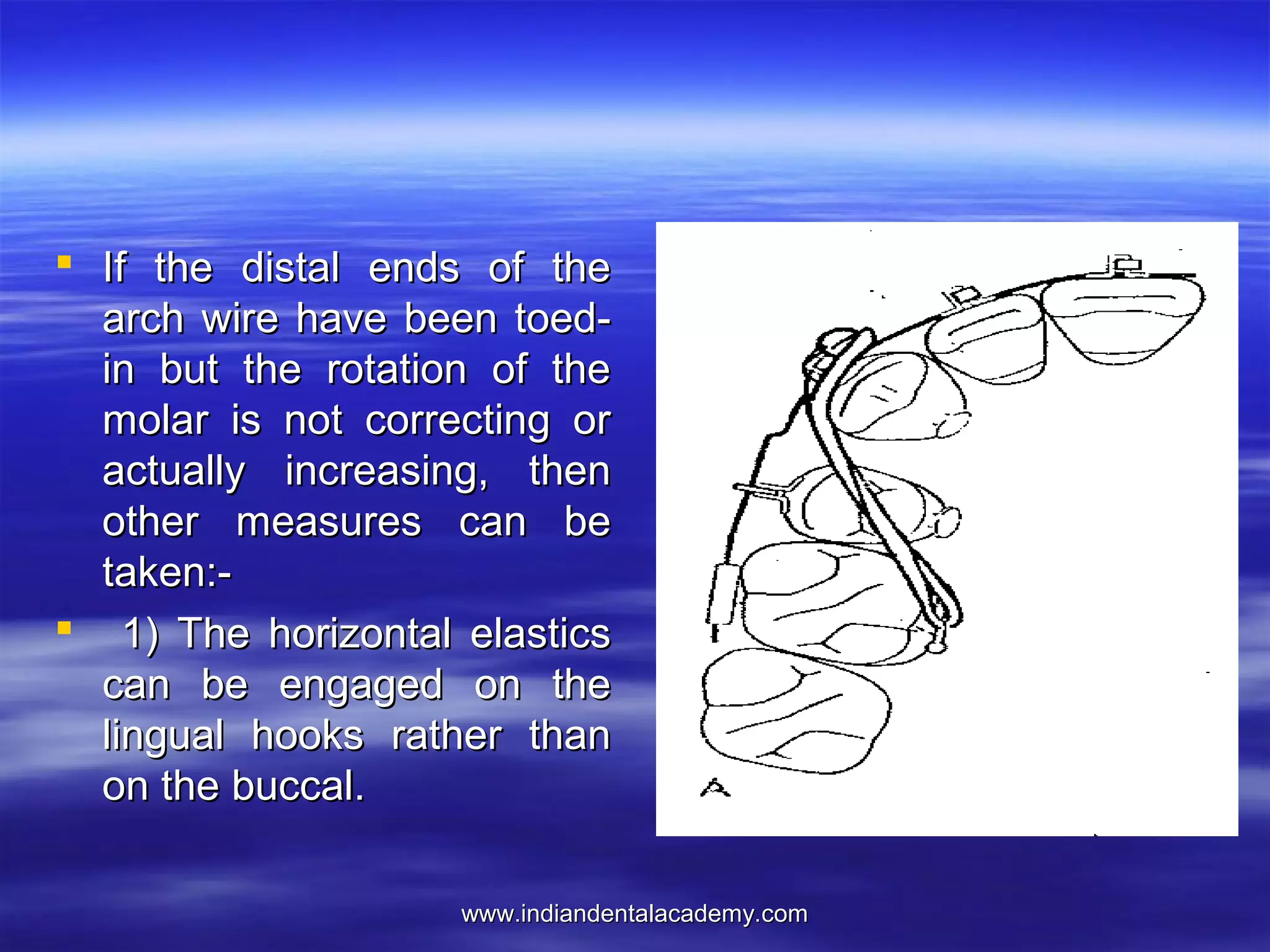 www.indiandentalacademy.comwww.indiandentalacademy.com
 If the distal ends of theIf the distal ends of the
arch wire have been toed-arch wire have been toed-
in but the rotation of thein but the rotation of the
molar is not correcting ormolar is not correcting or
actually increasing, thenactually increasing, then
other measures can beother measures can be
taken:-taken:-
 1) The horizontal elastics1) The horizontal elastics
can be engaged on thecan be engaged on the
lingual hooks rather thanlingual hooks rather than
on the buccal.on the buccal.
 