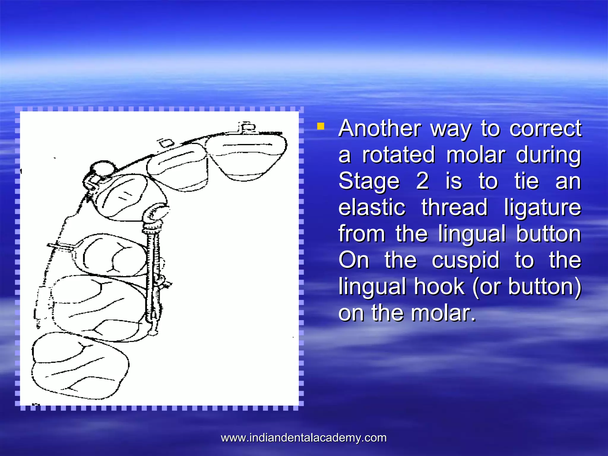 www.indiandentalacademy.comwww.indiandentalacademy.com
 Another way to correctAnother way to correct
a rotated molar duringa rotated molar during
Stage 2 is to tie anStage 2 is to tie an
elastic thread ligatureelastic thread ligature
from the lingual buttonfrom the lingual button
On the cuspid to theOn the cuspid to the
lingual hook (or button)lingual hook (or button)
on the molar.on the molar.
 