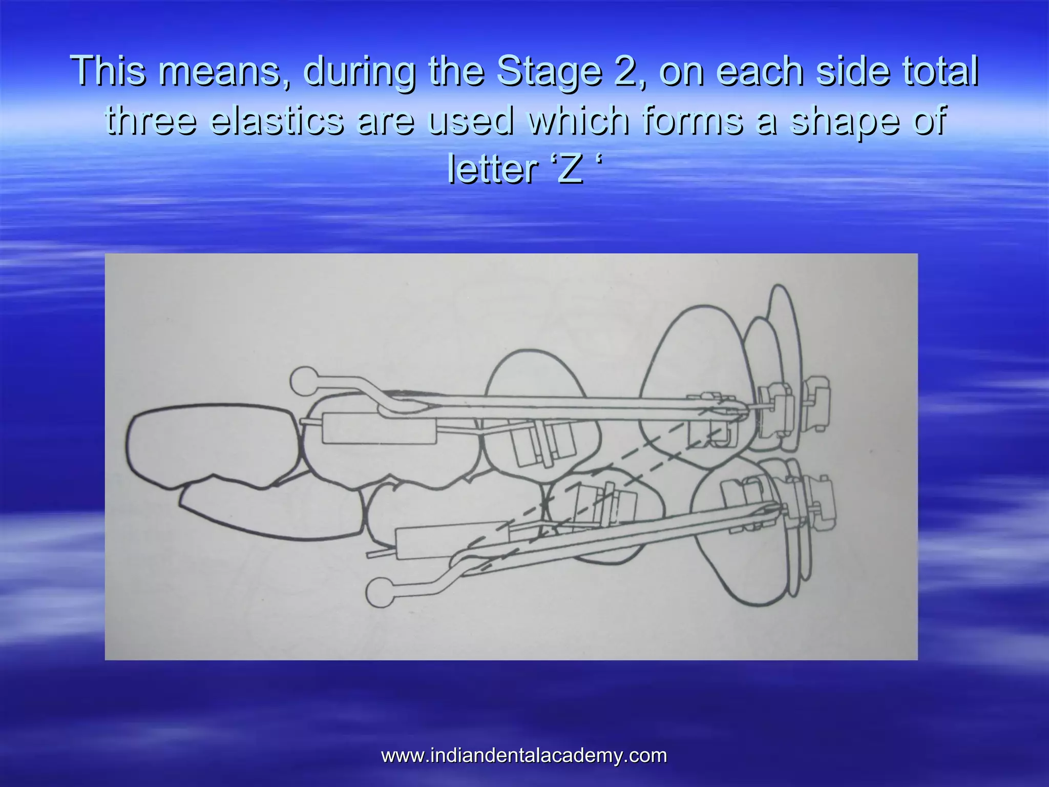 www.indiandentalacademy.comwww.indiandentalacademy.com
This means, during the Stage 2, on each side totalThis means, during the Stage 2, on each side total
three elastics are used which forms a shape ofthree elastics are used which forms a shape of
letter ‘Z ‘letter ‘Z ‘
 