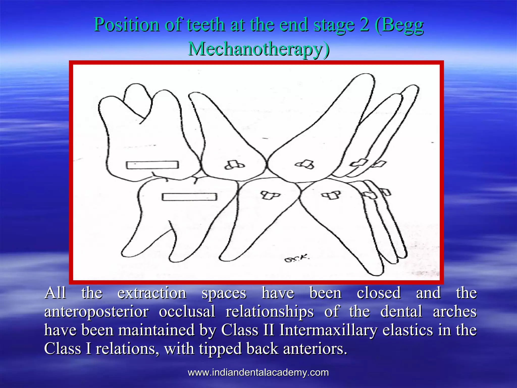 www.indiandentalacademy.comwww.indiandentalacademy.com
Position of teeth at the end stage 2 (BeggPosition of teeth at the end stage 2 (Begg
Mechanotherapy)Mechanotherapy)
All the extraction spaces have been closed and theAll the extraction spaces have been closed and the
anteroposterior occlusal relationships of the dental archesanteroposterior occlusal relationships of the dental arches
have been maintained by Class II Intermaxillary elastics in thehave been maintained by Class II Intermaxillary elastics in the
Class I relations, with tipped back anteriors.Class I relations, with tipped back anteriors.
 