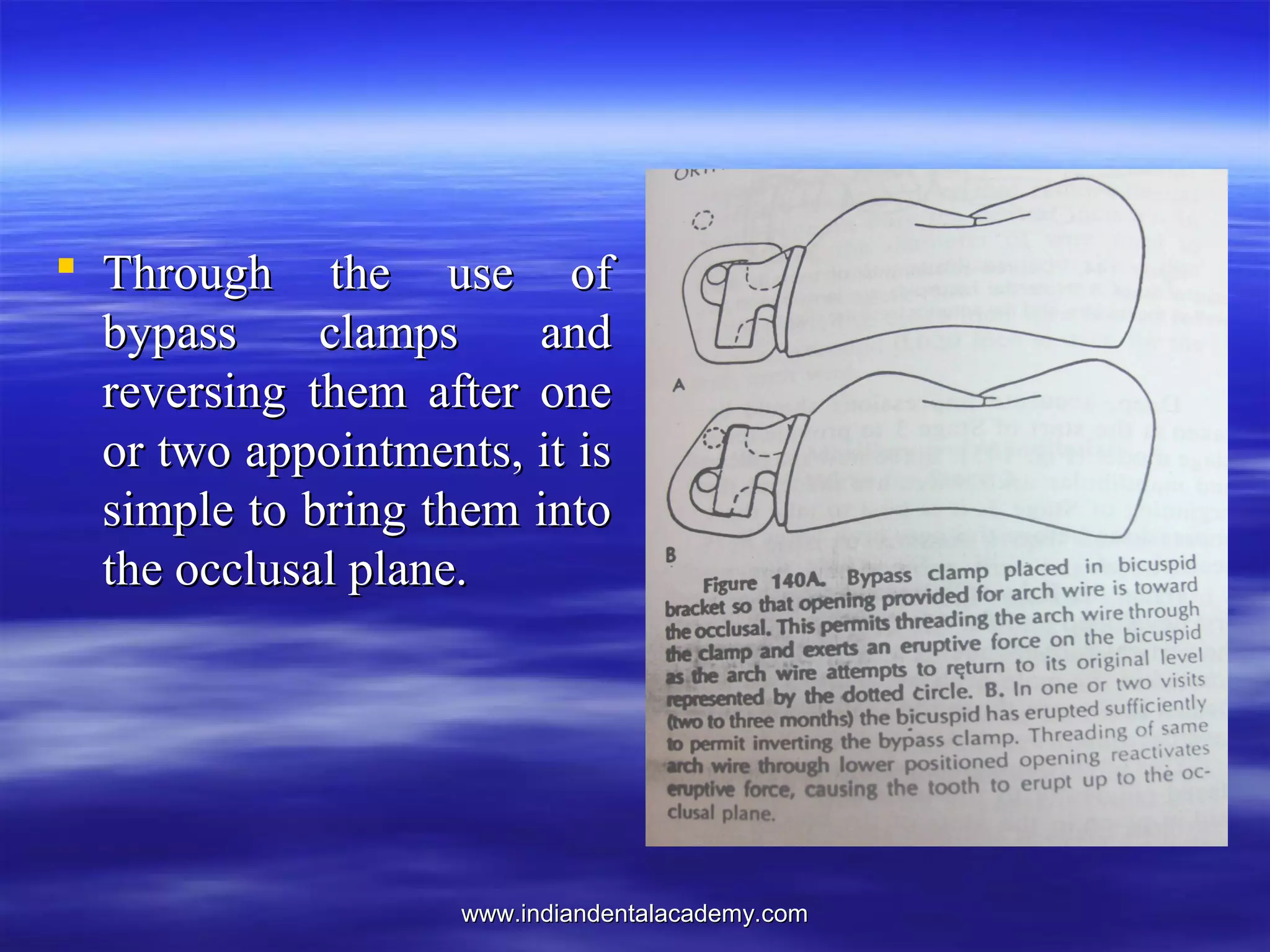 www.indiandentalacademy.comwww.indiandentalacademy.com
 Through the use ofThrough the use of
bypass clamps andbypass clamps and
reversing them after onereversing them after one
or two appointments, it isor two appointments, it is
simple to bring them intosimple to bring them into
the occlusal plane.the occlusal plane.
 