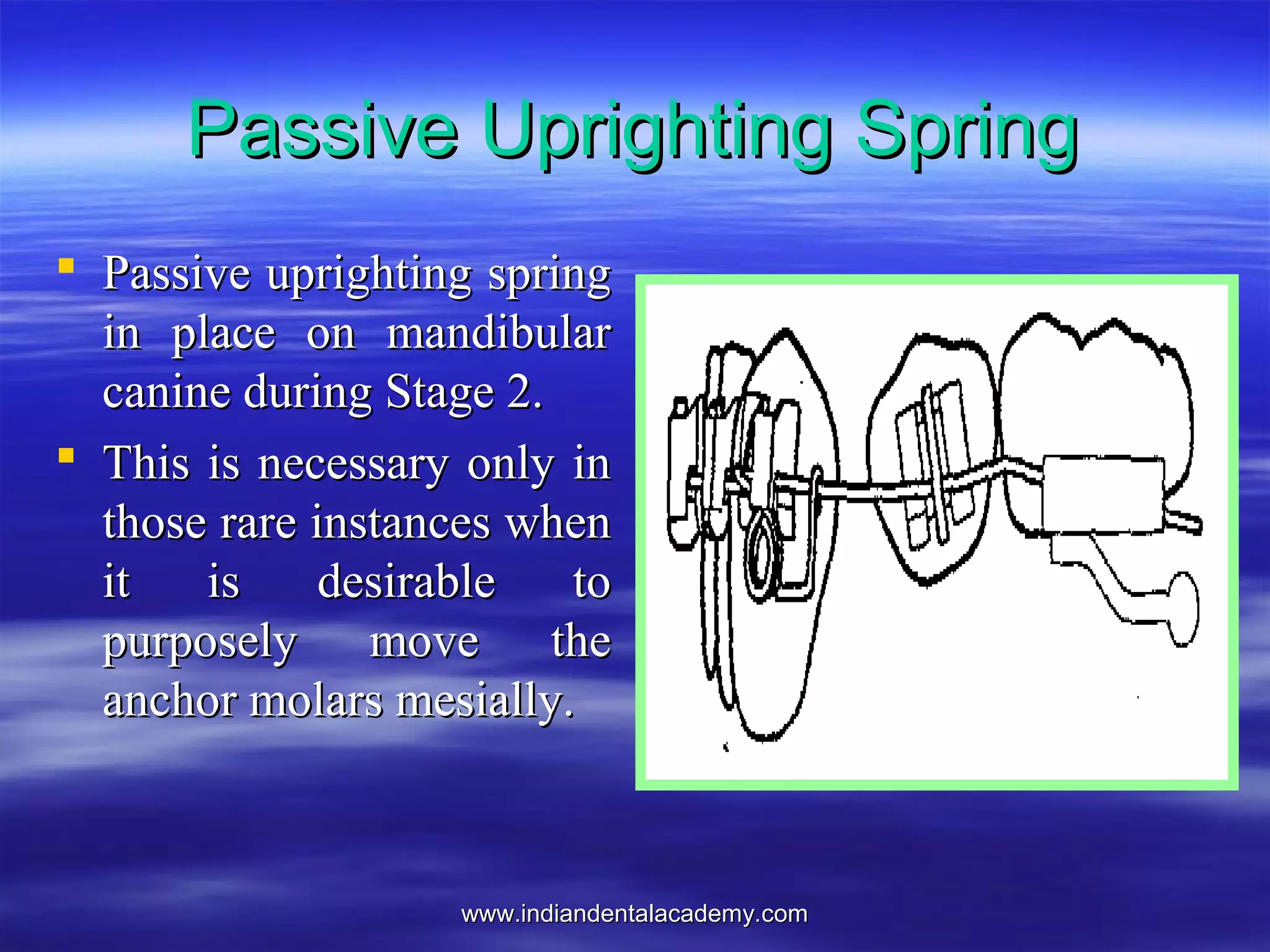 www.indiandentalacademy.comwww.indiandentalacademy.com
Passive Uprighting SpringPassive Uprighting Spring
 Passive uprighting springPassive uprighting spring
in place on mandibularin place on mandibular
canine during Stage 2.canine during Stage 2.
 This is necessary only inThis is necessary only in
those rare instances whenthose rare instances when
it is desirable toit is desirable to
purposely move thepurposely move the
anchor molars mesially.anchor molars mesially.
 