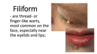 Filiform Style STAGES INFECTION.pptx
