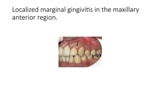 STAGES OF GINGIVAL INFLAMMATION PERIODONTICS | PPTX