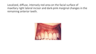 STAGES OF GINGIVAL INFLAMMATION PERIODONTICS | PPTX