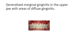 STAGES OF GINGIVAL INFLAMMATION PERIODONTICS | PPTX