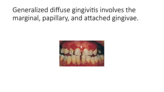 STAGES OF GINGIVAL INFLAMMATION PERIODONTICS | PPTX
