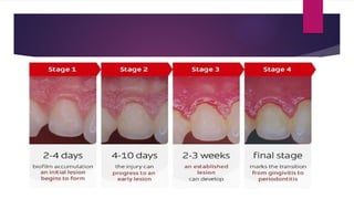 Saleek Rice STAGES OF GINGIVAL INFLAMMATION - SALEEK AT copy.pptx
