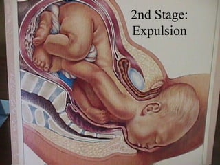2nd Stage: Expulsion 