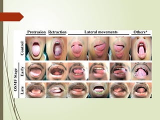 stages of osmf 2.pptx org.pptx for bds students | PPTX