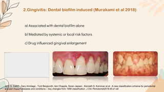 2.Gingivitis: Dental biofilm induced (Murakami et al 2018)
a) Associated with dental biofilm alone
b) Mediated by systemic or local risk factors
c) Drug influenced gingival enlargement
Jack G. Caton , Gary Armitage , Tord Berglundh, Iain Chapple, Soren Jepsen , Kenneth S. Kornman et al . A new classification scheme for periodontal
and peri implant diseases and conditions – key changes from 1999 classification. J Clin Periodontol2018;45:s1-s8
 