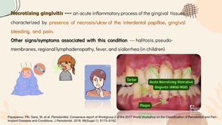 Necrotizing gingivitis --- an acute inflammatory process of the gingival tissues
characterized by presence of necrosis/ulcer of the interdental papillae, gingival
bleeding, and pain.
Other signs/symptoms associated with this condition --- halitosis, pseudo-
membranes, regional lymphadenopathy, fever, and sialorrhea (in children).
Papapanou, PN, Sanz, M, et al. Periodontitis: Consensus report of Workgroup 2 of the 2017 World Workshop on the Classification of Periodontal and Peri-
Implant Diseases and Conditions. J Periodontol. 2018; 89(Suppl 1): S173–S182.
 