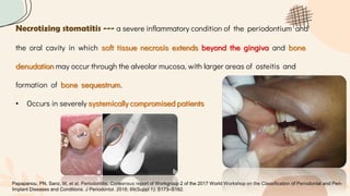 Necrotizing stomatitis --- a severe inflammatory condition of the periodontium and
the oral cavity in which soft tissue necrosis extends beyond the gingiva and bone
denudation may occur through the alveolar mucosa, with larger areas of osteitis and
formation of bone sequestrum.
• Occurs in severely systemically compromised patients
Papapanou, PN, Sanz, M, et al. Periodontitis: Consensus report of Workgroup 2 of the 2017 World Workshop on the Classification of Periodontal and Peri-
Implant Diseases and Conditions. J Periodontol. 2018; 89(Suppl 1): S173–S182.
 