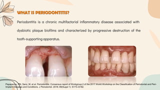 WHAT IS PERIODONTITIS?
Periodontitis is a chronic multifactorial inflammatory disease associated with
dysbiotic plaque biofilms and characterized by progressive destruction of the
tooth-supporting apparatus.
Papapanou, PN, Sanz, M, et al. Periodontitis: Consensus report of Workgroup 2 of the 2017 World Workshop on the Classification of Periodontal and Peri-
Implant Diseases and Conditions. J Periodontol. 2018; 89(Suppl 1): S173–S182.
 