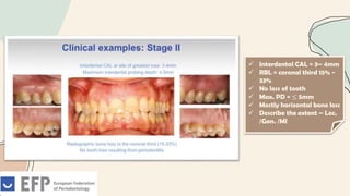  Interdental CAL = 3– 4mm
 RBL = coronal third 15% -
33%
 No loss of tooth
 Max. PD = ≤ 5mm
 Mostly horizontal bone loss
 Describe the extent – Loc.
/Gen. /MI
 