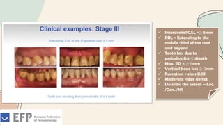  Interdental CAL =≥ 5mm
 RBL = Extending to the
middle third of the root
and beyond
 Tooth loss due to
periodontitis ≤ 4teeth
 Max. PD = ≥ 6mm
 Vertical bone loss ≥ 3mm
 Furcation = class II/III
 Moderate ridge defect
 Describe the extent – Loc.
/Gen. /MI
 