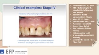  Interdental CAL =≥ 5mm
 RBL = Extending to the
middle third of the root
and beyond
 Tooth loss due to
periodontitis ≥ 5teeth
 Max. PD = ≥ 6mm
 Vertical bone loss ≥ 3mm
 Furcation = class II/III
 Severe ridge defect
 Bite collapse, drifting,
flaring
 <20 remaining teeth
 2° occlusal trauma / G-II
mobility
 Describe the extent – Loc.
/Gen. /MI
 