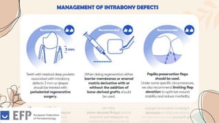 MANAGEMENT OF INTRABONY DEFECTS
 