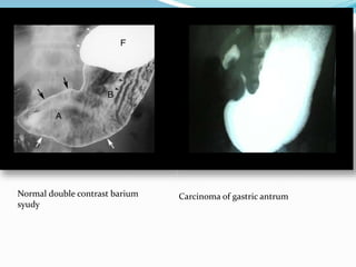 Normal Antrum Visual Staging and management of ca stomach | PPTX