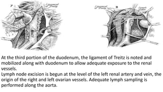 At the third portion of the duodenum, the ligament of Treitz is noted and
mobilized along with duodenum to allow adequate exposure to the renal
vessels.
Lymph node excision is begun at the level of the left renal artery and vein, the
origin of the right and left ovarian vessels. Adequate lymph sampling is
performed along the aorta.
 