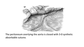 The peritoneum overlying the aorta is closed with 3-0 synthetic
absorbable sutures.
 